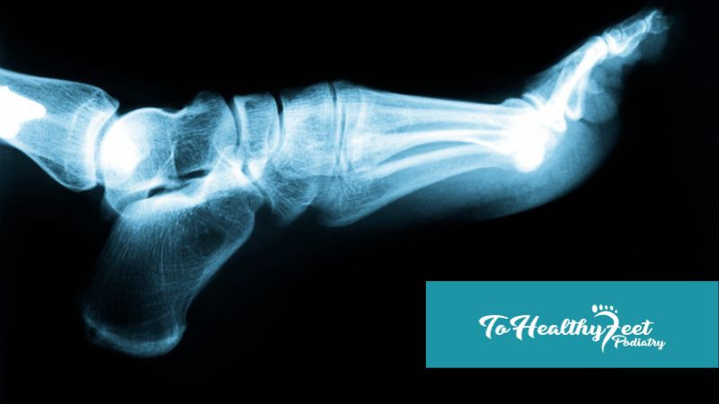 How To Prevent Ankle Fractures | Manhattan Podiatrist - NYC